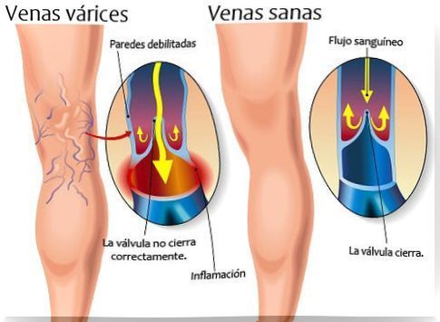 Difference between a healthy leg and one with varicose veins