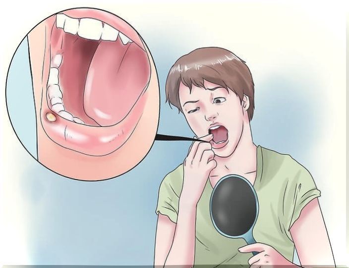 8 natural remedies for mouth ulcers