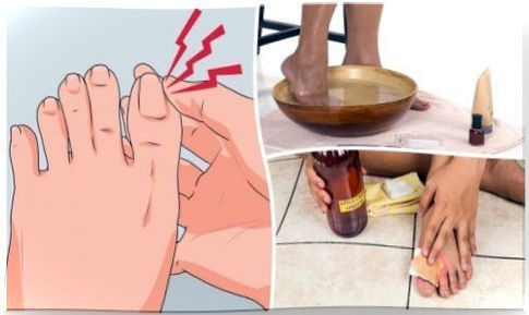 Fight ingrown toenails with these 6 home remedies