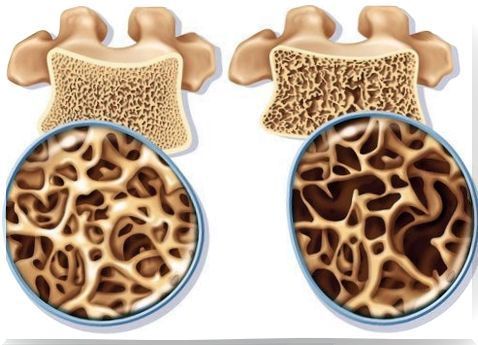 Osteoporysis