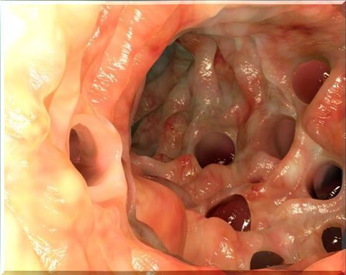 Colon with diverticulitis